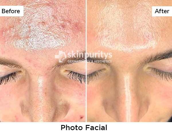 Facial  results